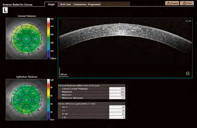 ANTERIOR-SEGMENT-ANALYSIS