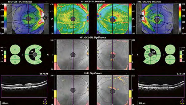 Glaucoma