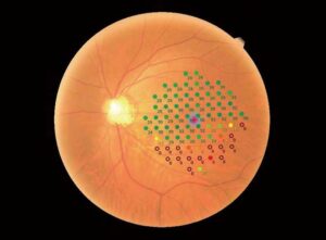 MP-3-Glaucomatous-Eye-Image