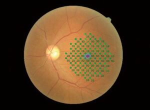 MP-3-Normal-Eye-Image