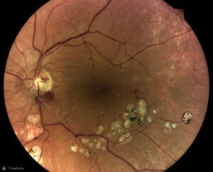 Retinal-vein-occlusion_OS_central_color_web