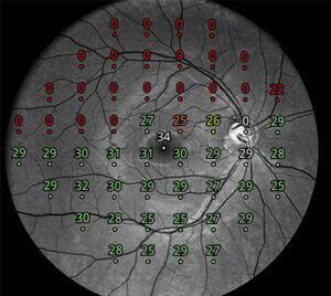 Visual-field-test