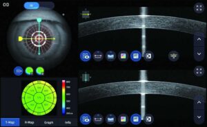 anterior-corneal-measurement