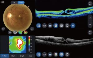 fundus-camera