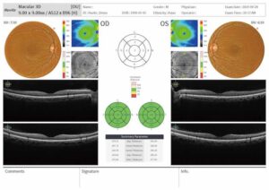 report-macular-3d