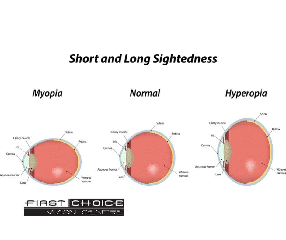 what-is-myopia